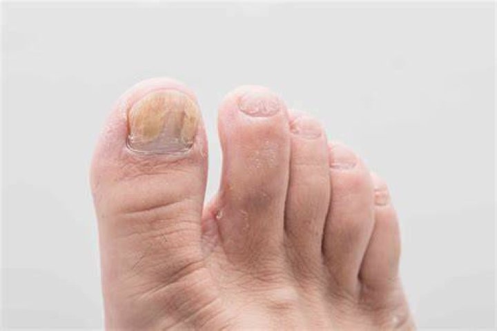 Toenail Problems